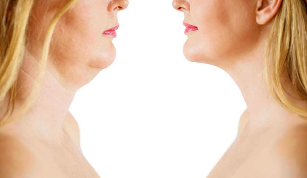Double Chin treatment Banbury before and after results