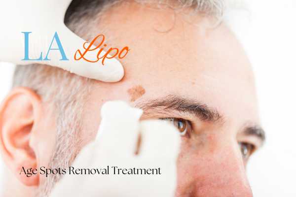 What Are the Most Effective Treatments for Age Spots Banbury?