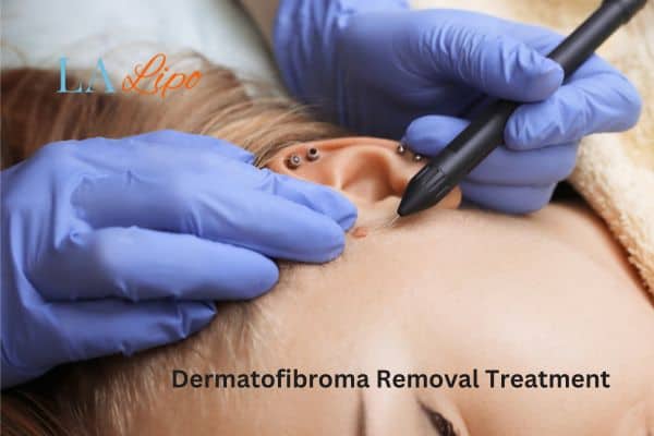 Dermatofibroma Removal Treatment Banbury