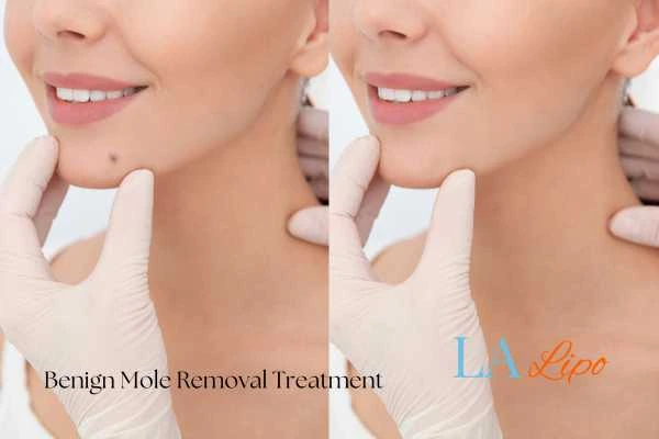 woman's before and after mole removal Banbury results