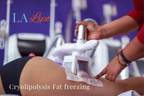 women getting fat freezing Banbury