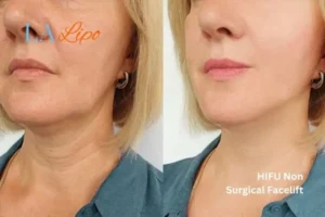 hi-fu for wrinkles Banbury before and after results