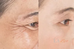 Before and after results of woman - HI-fu wrinkles reduction treatment Banbury