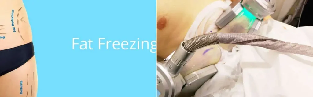 Fat freezing Banbury on multiple areas of the body
