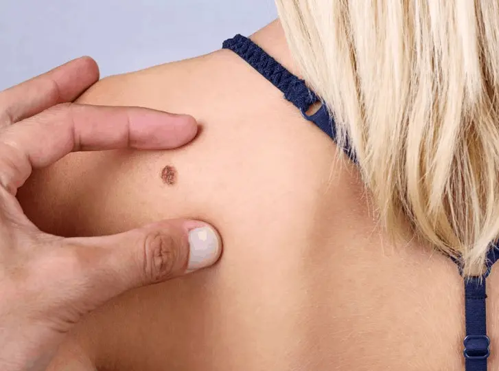 woman having mole removal Banbury consultation before treatment.