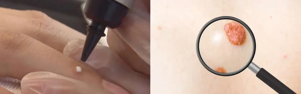 Cryopen for mole removal Banbury - speak to our team today!