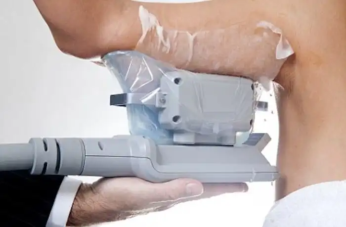 Picture of fat freezing Banbury on the upper arms.