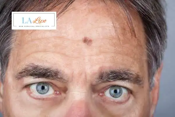 Solar Lentigo Removal Banbury image of man with mark on his forehead