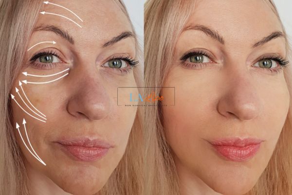 Morpheus 8 results Banbury face lift.