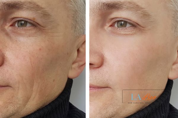 See the amazing results of Morpheus8 Treatment Banbury!