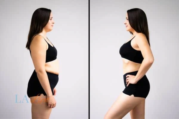 Picture of womans before and after using LA-EMS body sculpting to improve her core strength Banbury