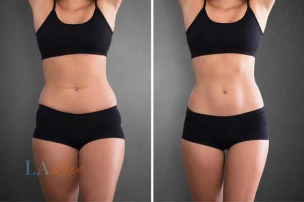 before and after results of non-surgical treatment to help a woman's body image and mental health Banbury