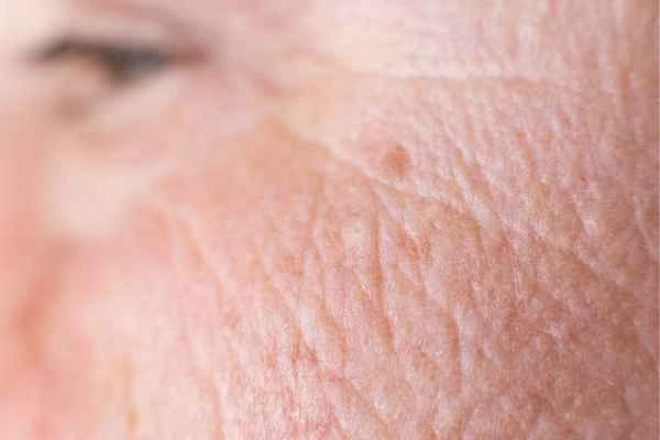 close up picture of a woman's face showing an age spot Banbury