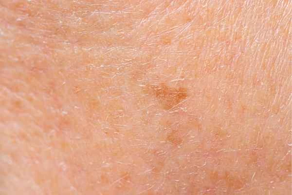 close up picture of age spots Banbury