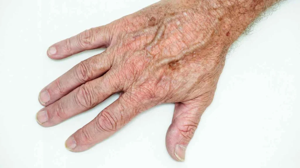 Male hand showing age spot Banbury