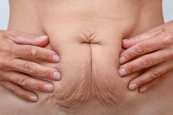 Should I Combine Diastasis Recti Treatment with Body Contouring for Better Results Banbury?