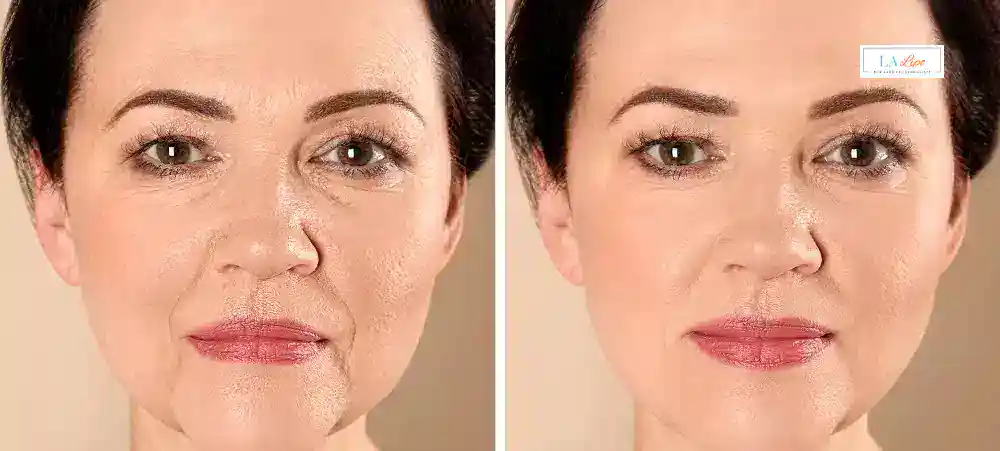 How Long Does It Take to See Results and How Long Do They Last Banbury?